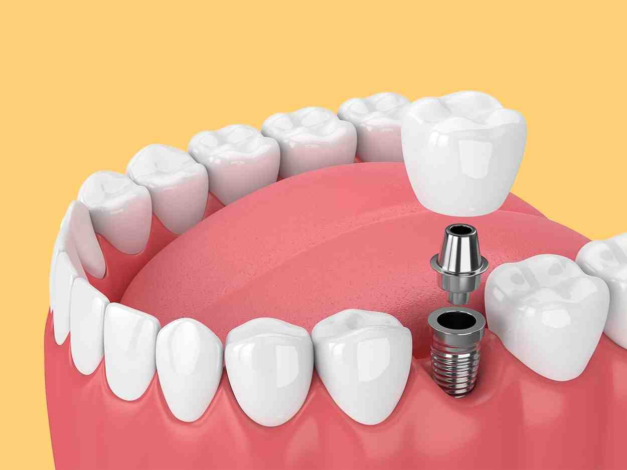 Do dental implants have high success rate?