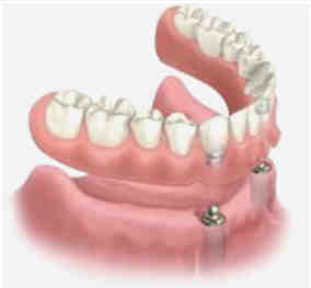 Do dental implants have to be removed to clean?