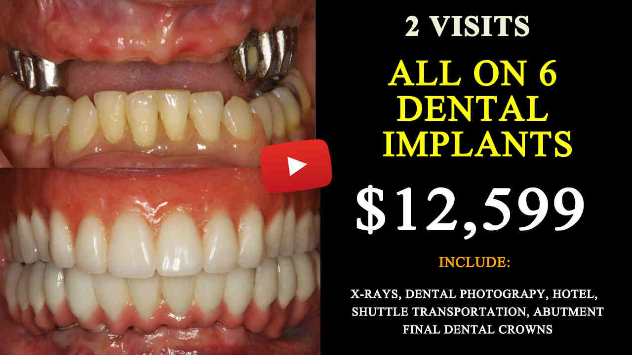 Do dental implants hurt?