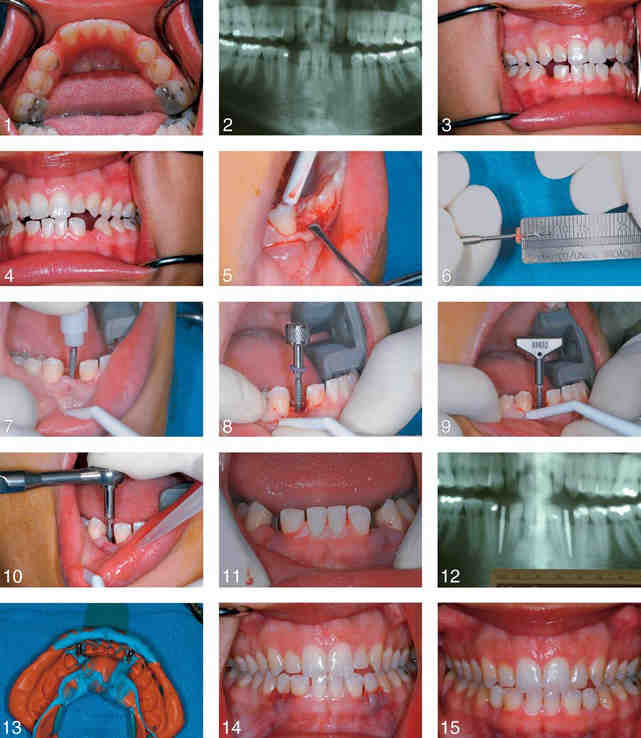 Do dental implants hurt?