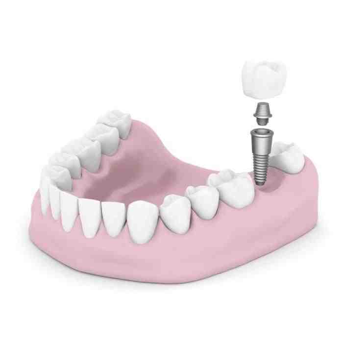 Do dental implants hurt?