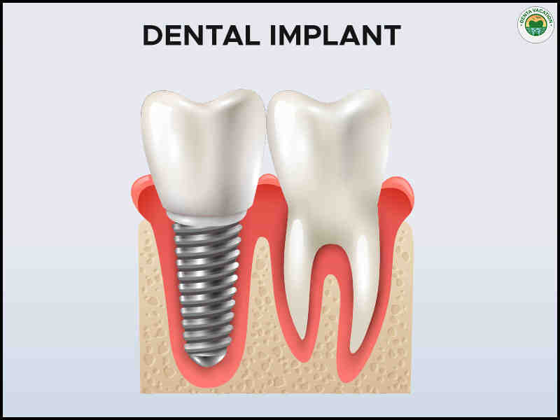 Do dental implants hurt?