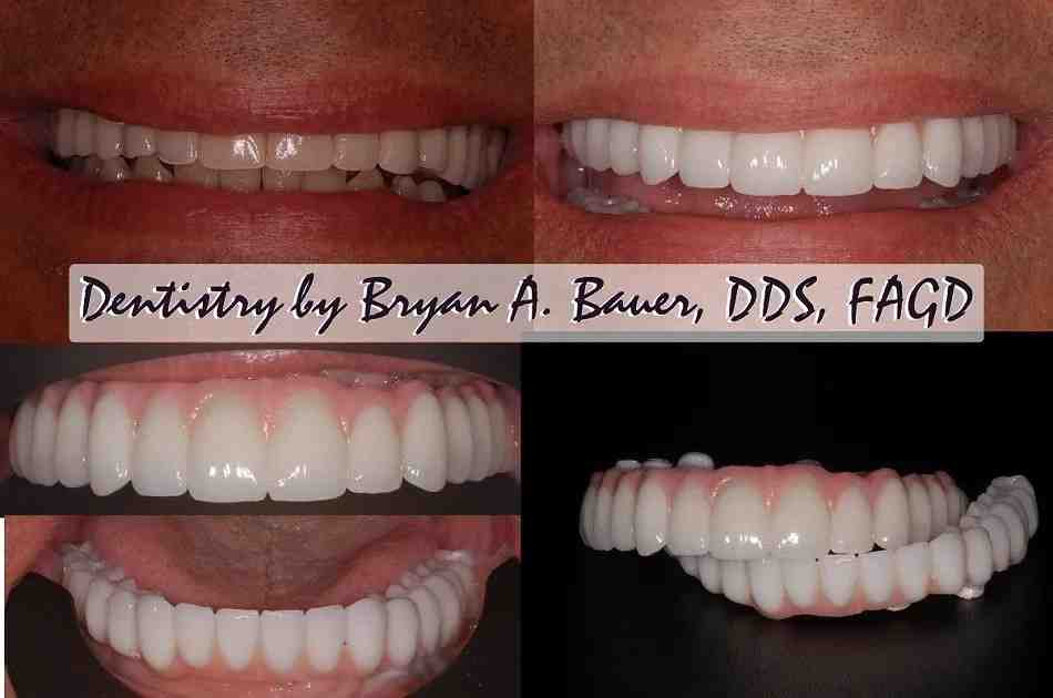 Do dental implants hurt?