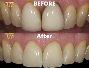 Do dental implants hurt?