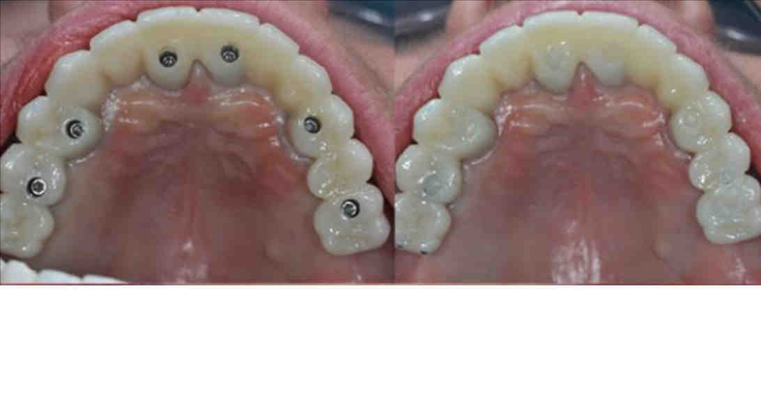 Do dental implants last forever?