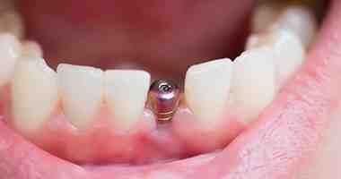 Do dental implants look natural?