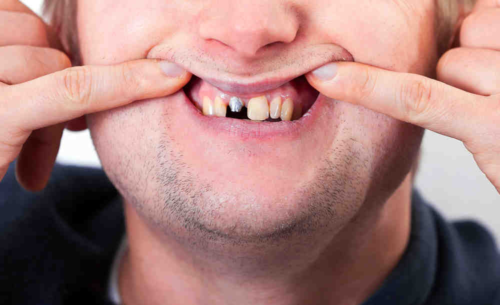 Do dental implants lower life expectancy?