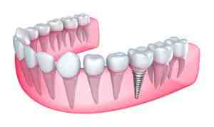 Do dental implants lower life expectancy?