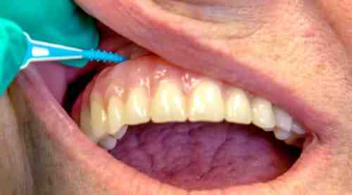 Do dental implants shorten your life?