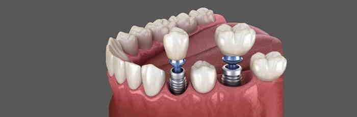 Do dental implants shorten your life?