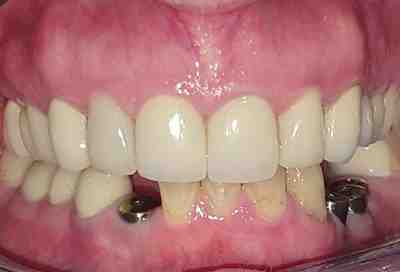 Do dental implants shorten your life?