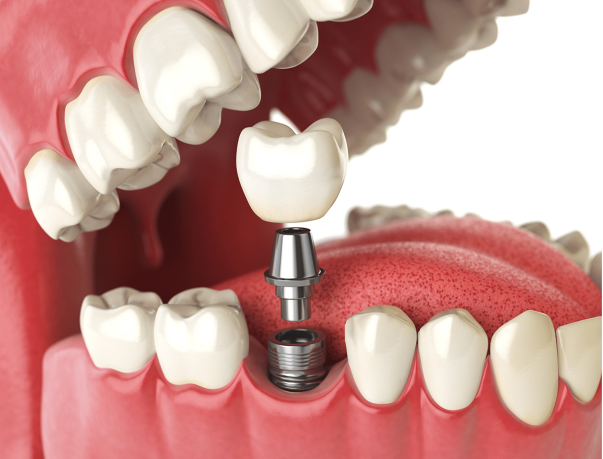 Do dental implants shorten your life?