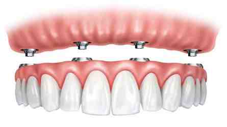 Do dental implants stain easily?
