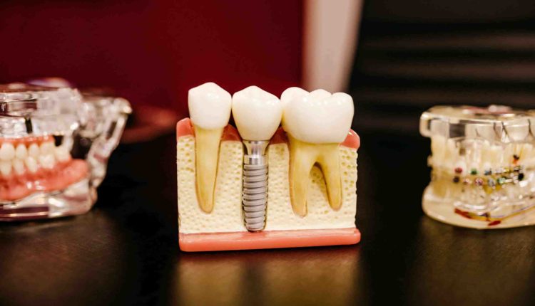 Do dental implants take better to new grown bone