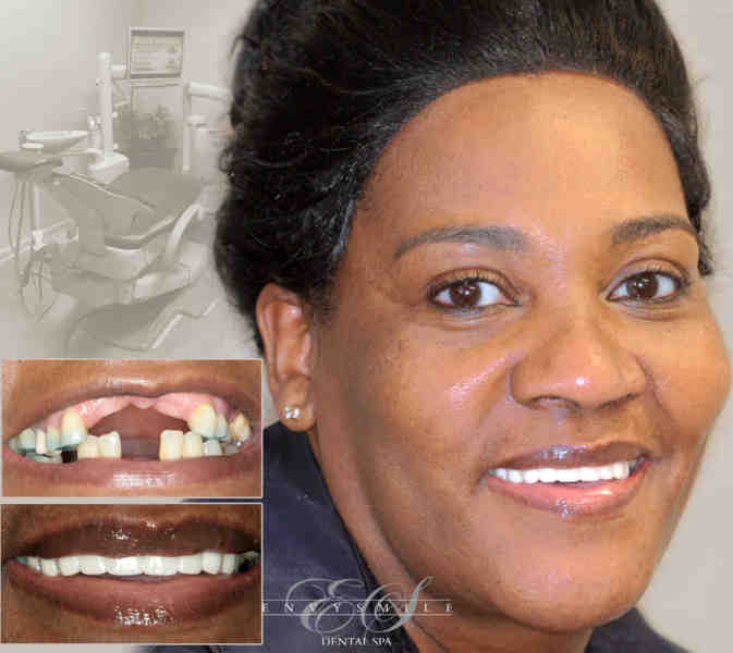 Do full mouth dental implants hurt?
