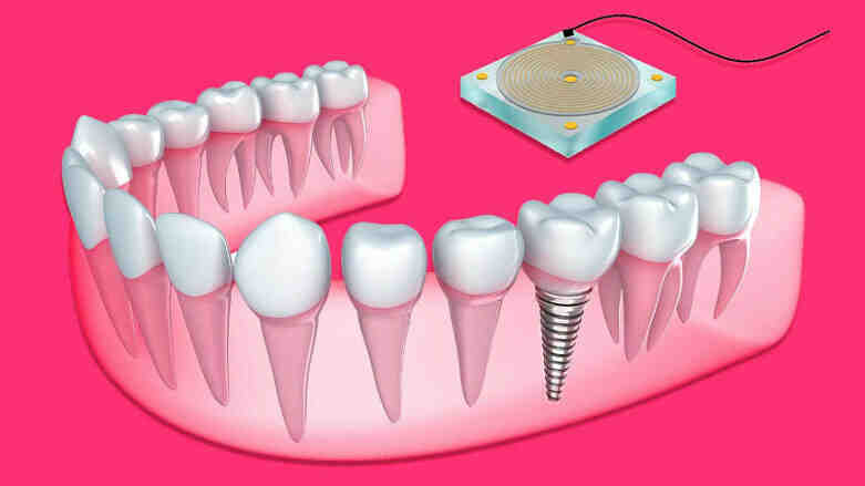 Do gums grow back around implants?