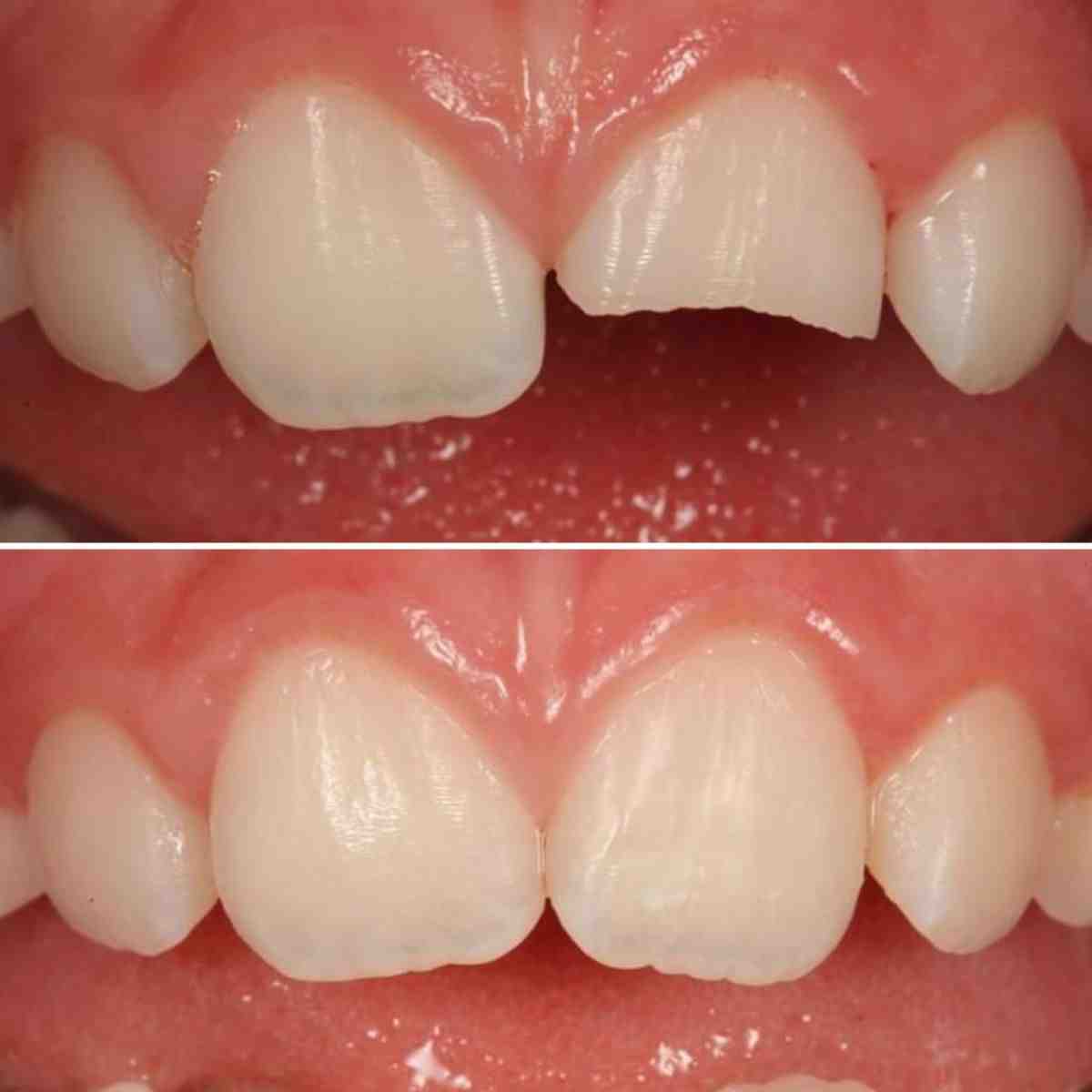 Do holistic dentist believe in root canals?
