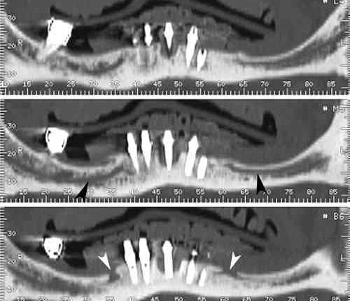 Do i need ct scan for dental implant