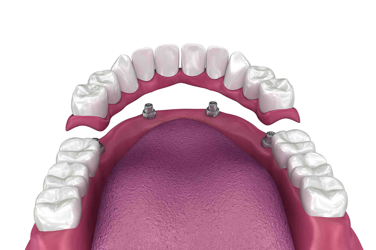 Do implant supported dentures have to be removed at night?