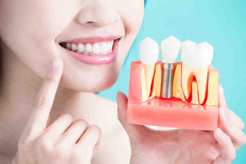 Do insurance cover dental implants?