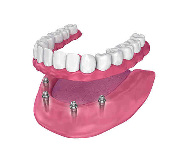 Do mini implants break?