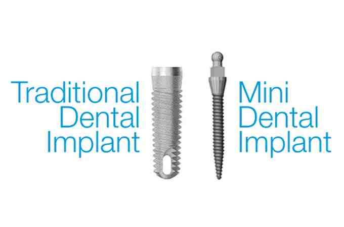 Do mini implants prevent bone loss?