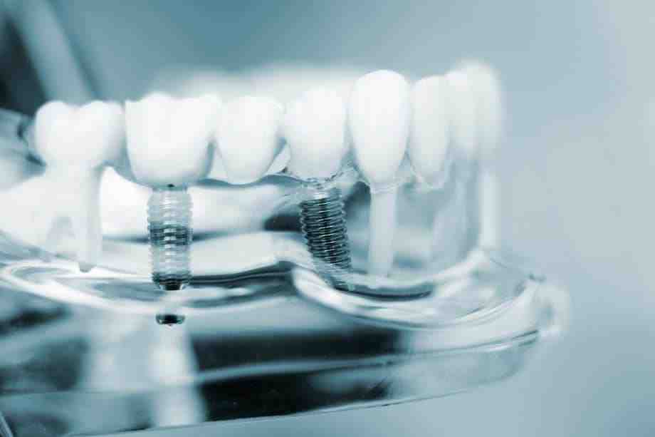 Do mini implants prevent bone loss?