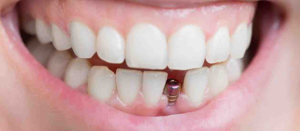 Do not get dental implants?