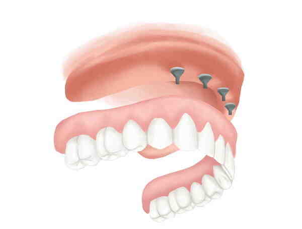 Do teeth implants fall out?