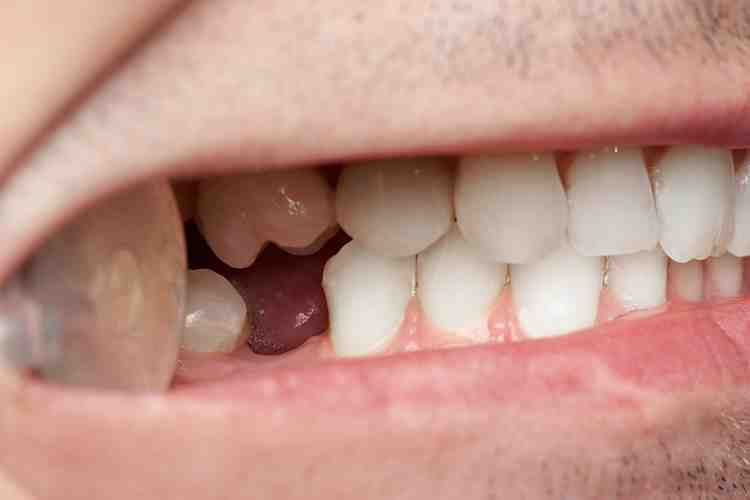 Do teeth implants hurt?