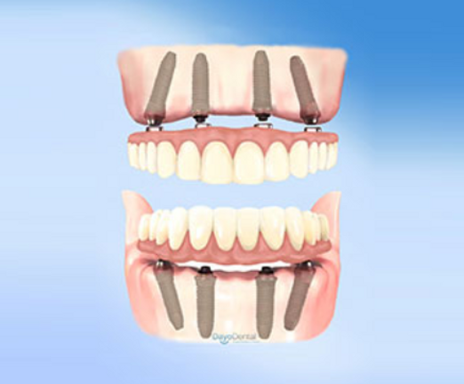 Do they put you to sleep for dental implants?