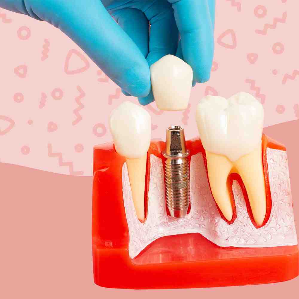 Do tooth implants smell?