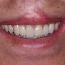 Do veneers feel weird at first?