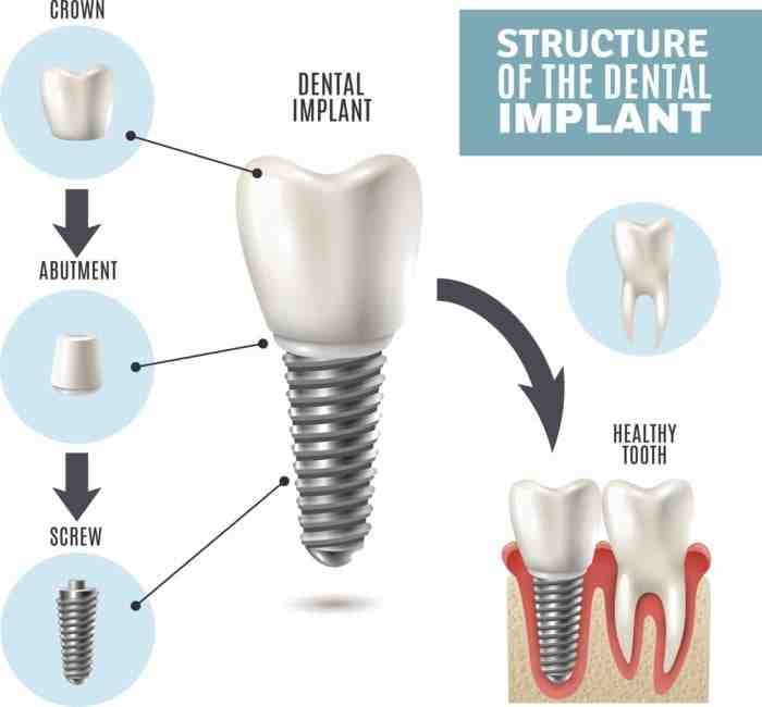 Do you need anesthesia for abutment?