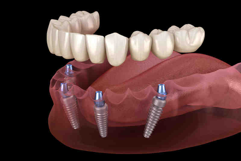 Do you need pain meds after dental implants?