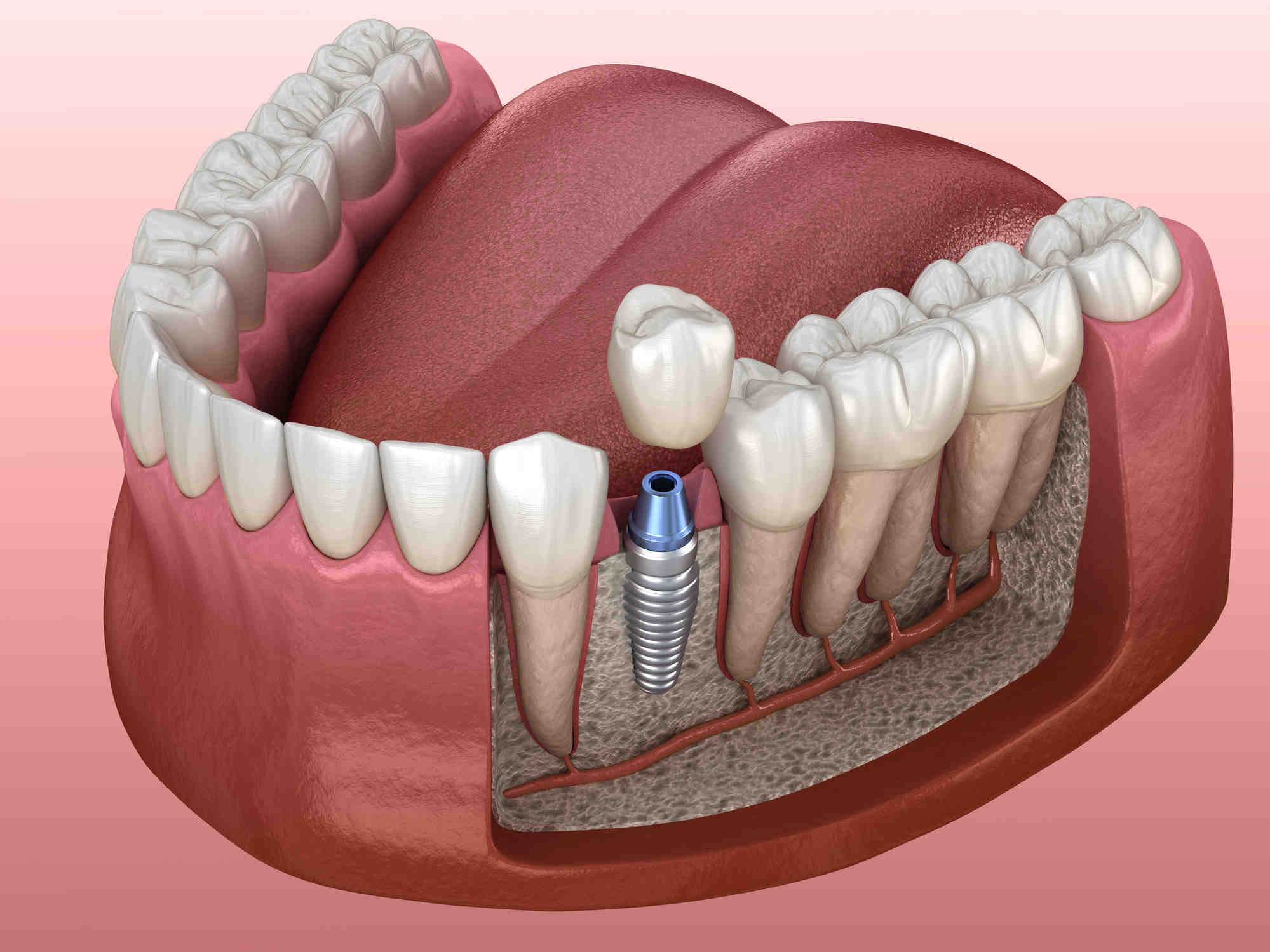 Do you need to be put to sleep for dental implants?