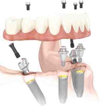 Do you still have to floss with implants?
