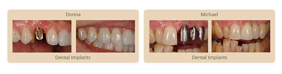Does Medi Cal or Medicare cover dental implants?