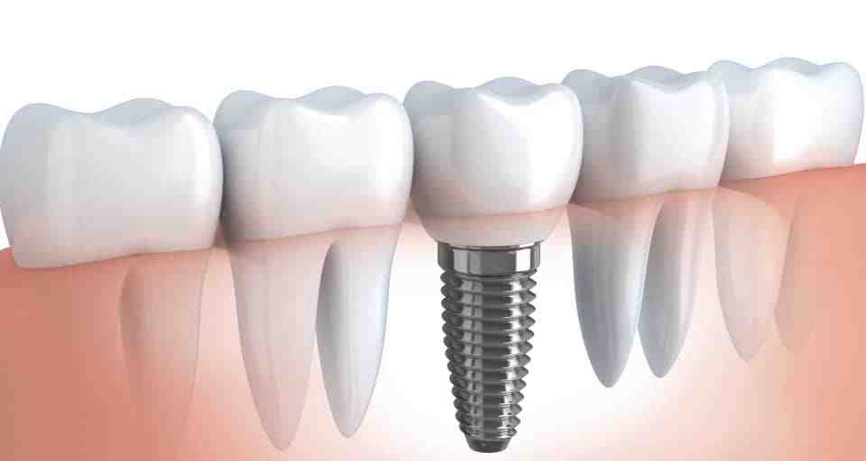 Does Medicaid cover veneers?