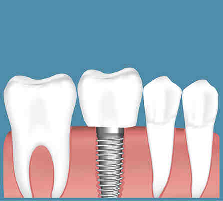 Does Medicare pay anything for implants?