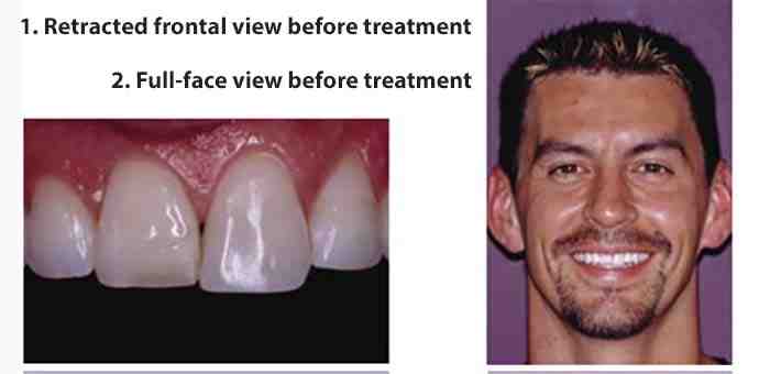 Does Miley Cyrus have veneers?