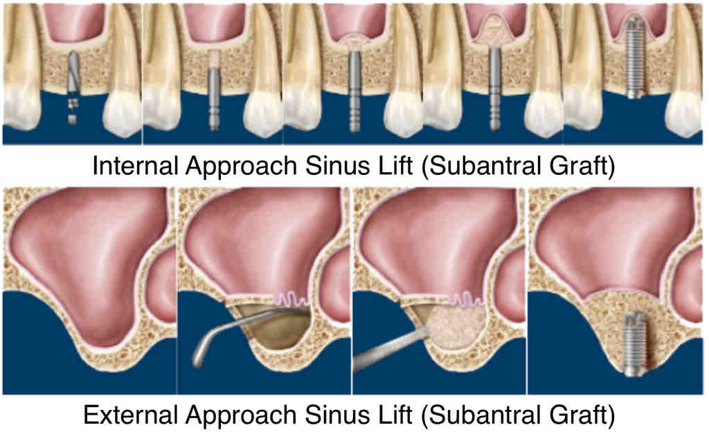 Does a sinus lift affect your breathing?