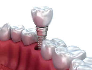 Does alcohol affect dental implants?