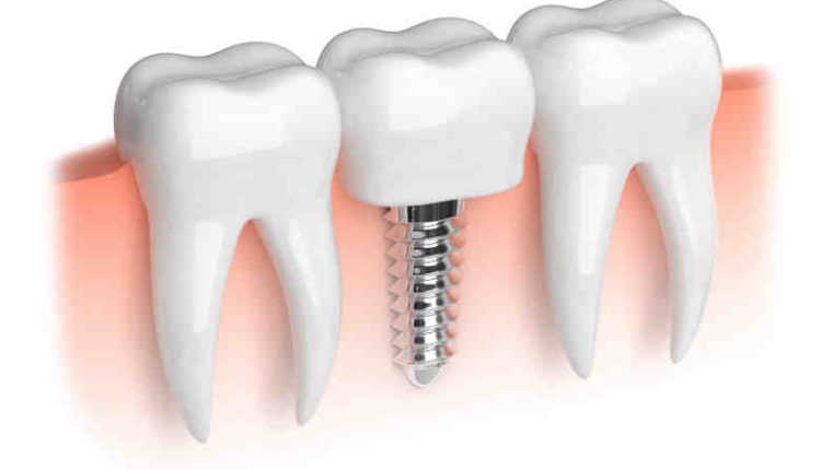Does blue cross cover full dental implants