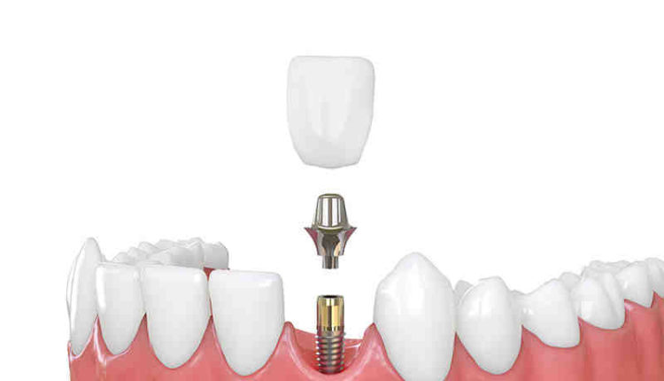 Does dental implants get rid of bad breath?