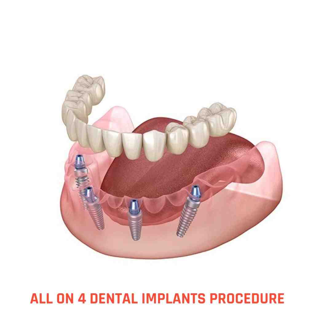 Does food get under dental implants?