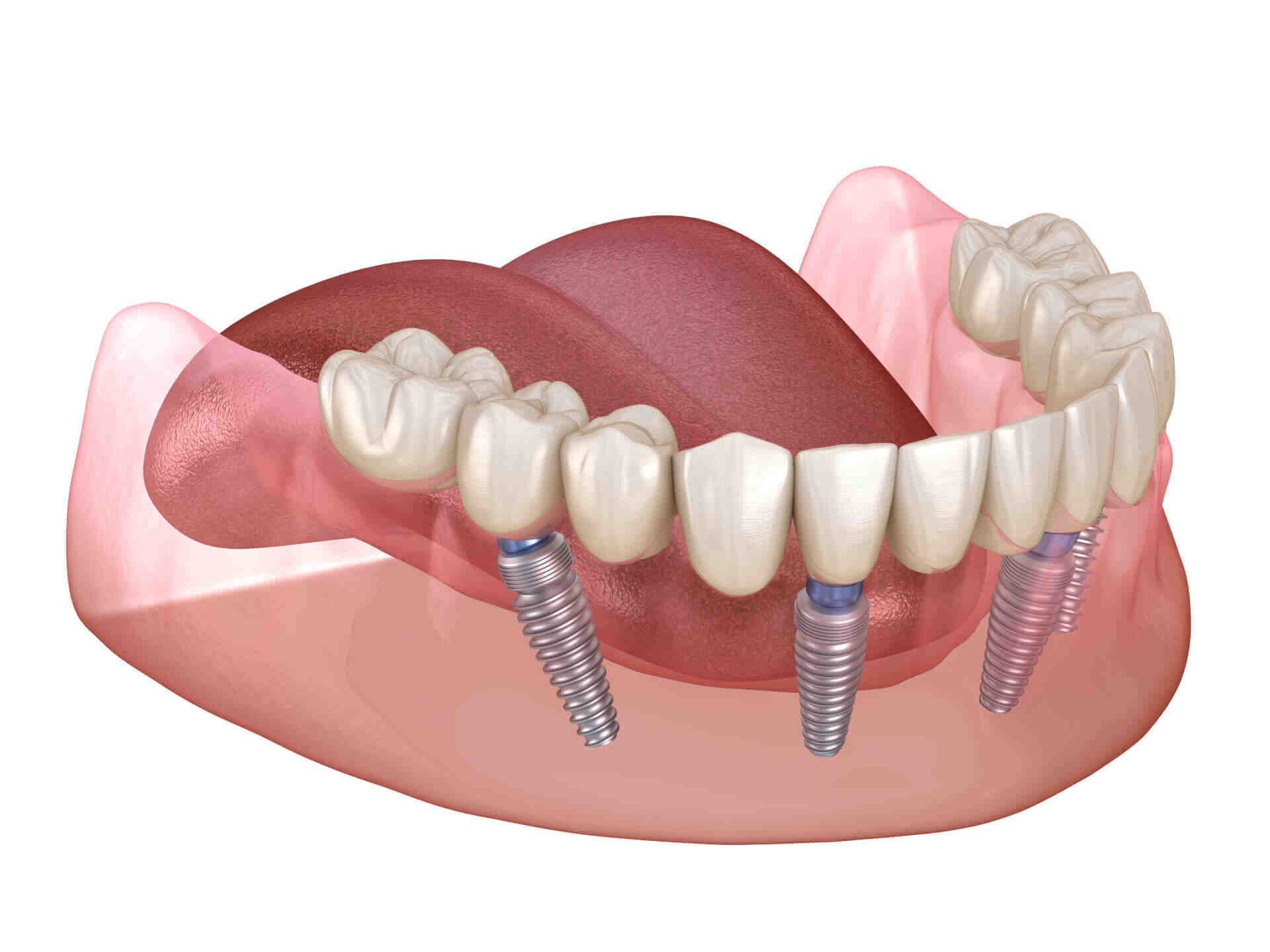 Does food get under dental implants?
