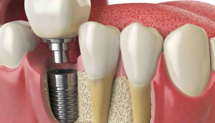 Does humana dental cover implants?