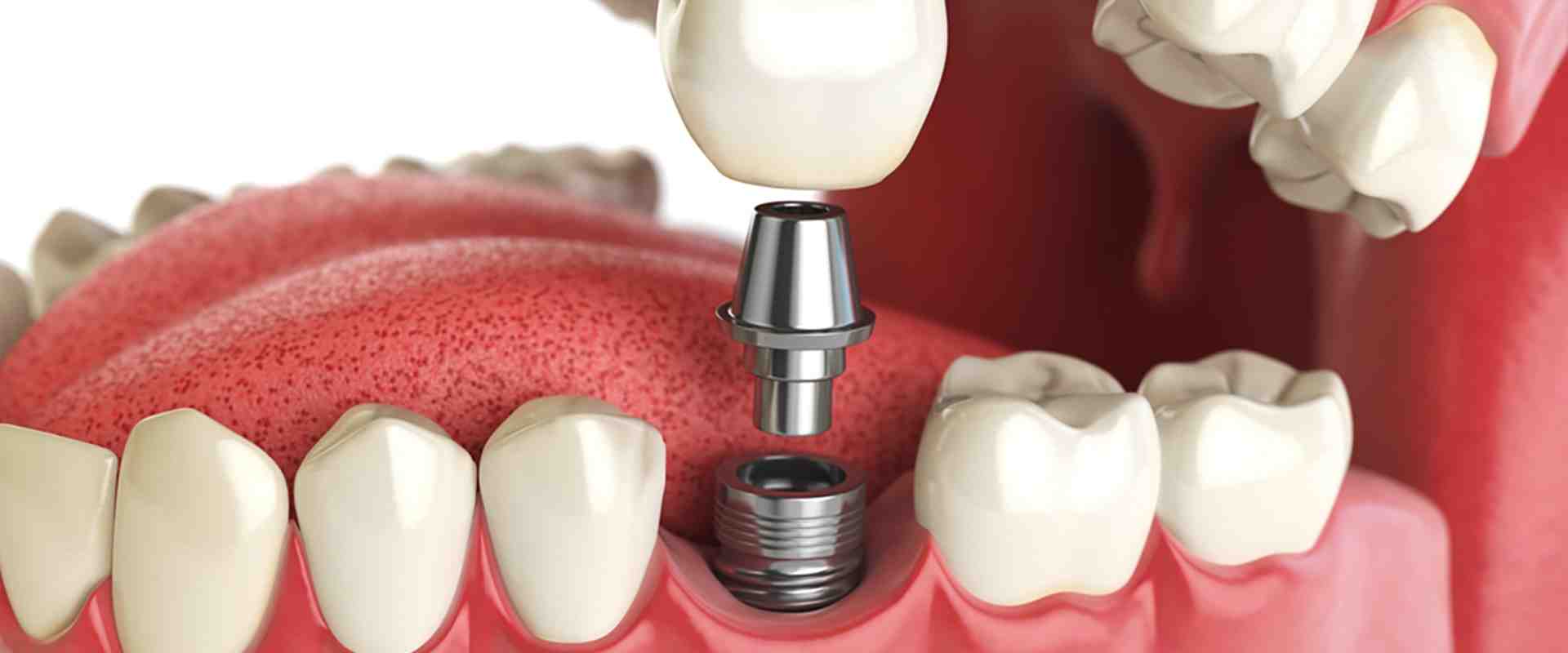 Are dental implants necessary Dental News Network