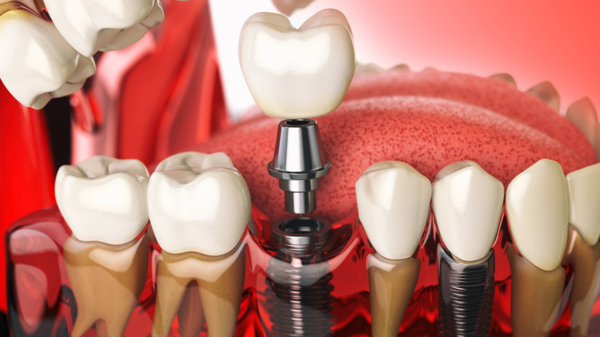 Does plaque build up on implants?